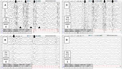 Frontiers Eeg Biomarkers For The Diagnosis And Treatment Of Infantile